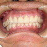 50代プロセラ症例