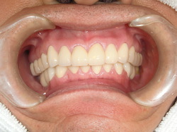 2010年3月に完治の症例（59歳男性　下あご奥歯欠損　allプロセラ治療）