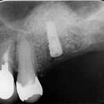 0000004610_nt_IntraOral_20191113112826
