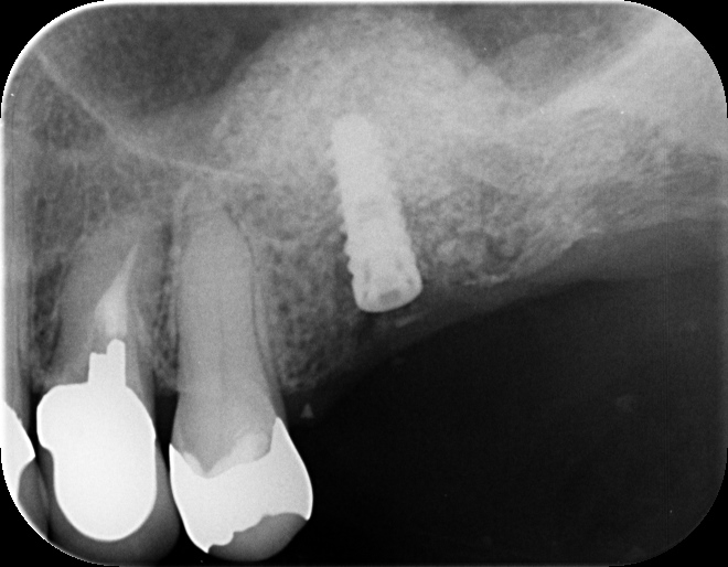 70代女性　上あごの骨量の不足を侵襲の少ないラテラルスリット法サイナスリフトにて行った本日のオペ