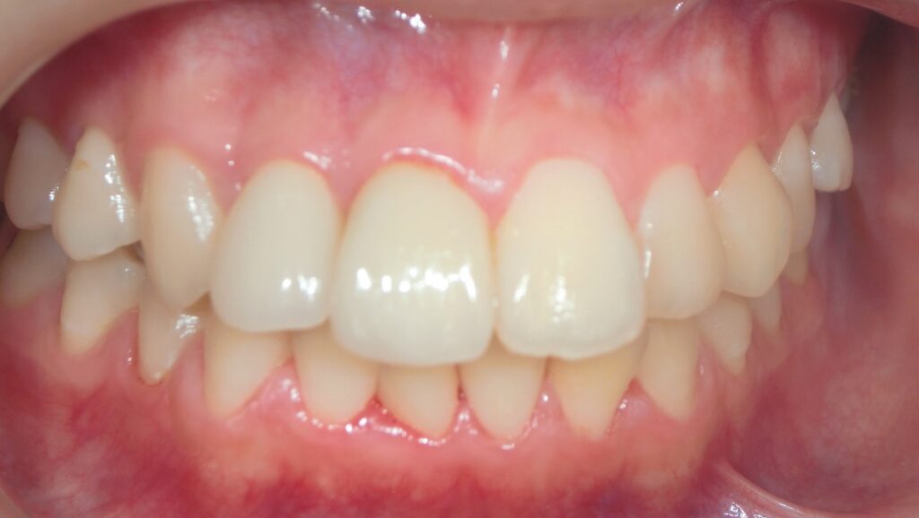 天然歯と同じ自然な美しさ　だけじゃない笹尾歯科医院　前歯編