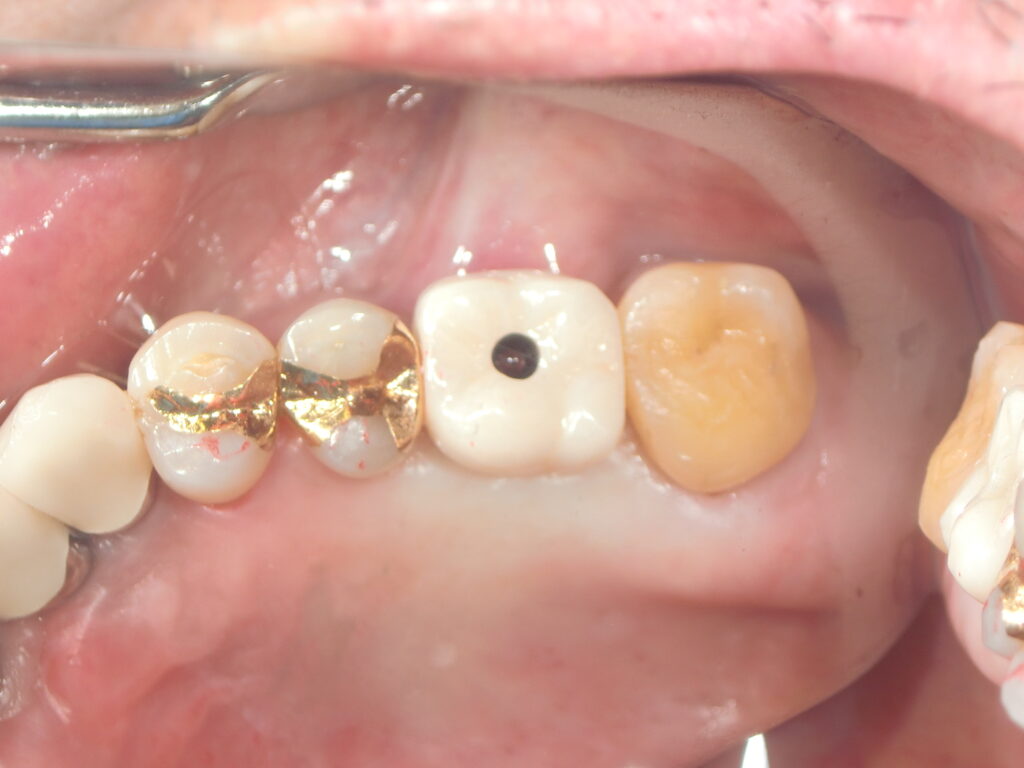 インプラントしたらMRIできないんですか？