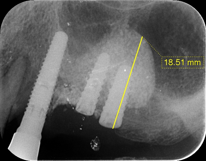 ２０２１年５月１９日の症例　７８歳男性左うえ５６　ラテラルスリット法（歯科医師向け）　