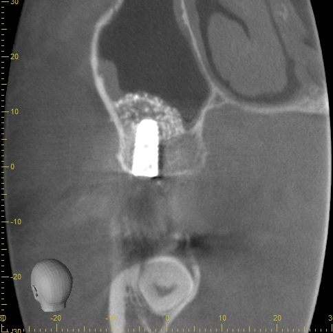 ２０２２年１０月２２日　本日のオペ　４０代男性　サイナスリフト・ラテラルスリット法