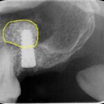 0000006298_井口-法紀_IntraOral_20230201121728