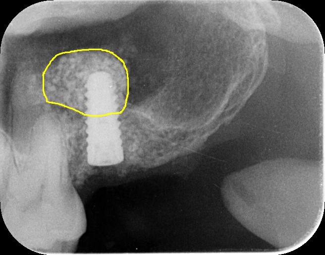 2023年2月1日のオペ　３０代男性　サイナスリフト（ラテラルスリット法）