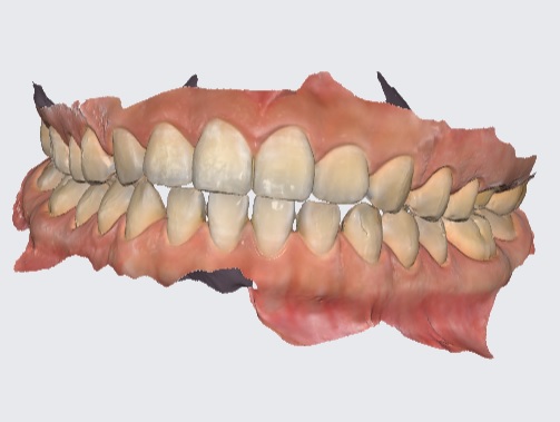 口腔内スキャナーを導入しました
