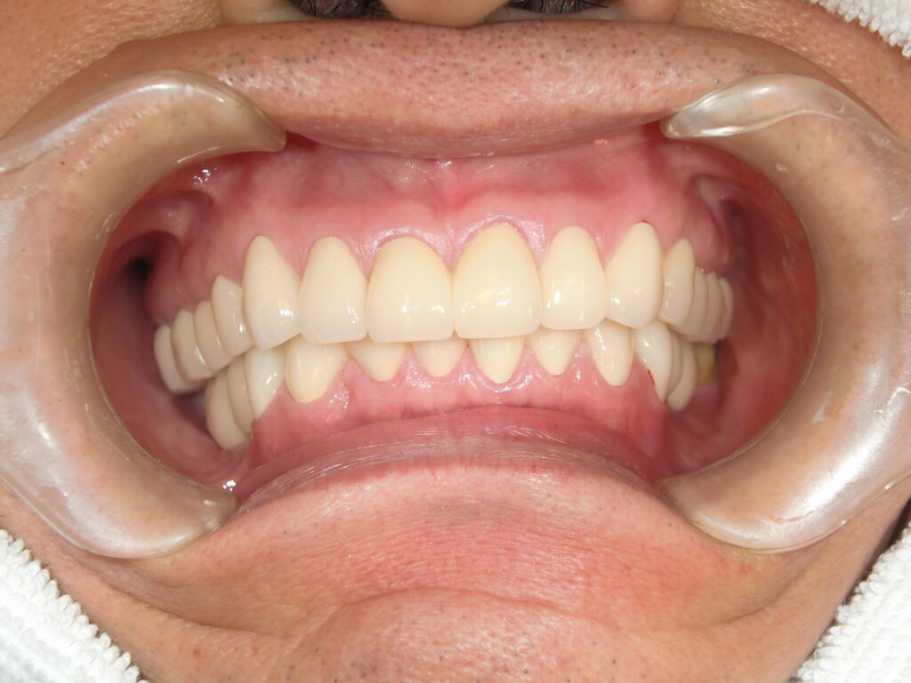 インプラント治療　14年経過症例