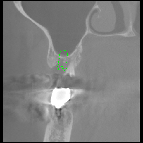 骨が不足で大学病院レベルのインプラントを安全に入れたい　51歳女性