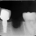 骨増生の必要性について 骨増生の必要性について