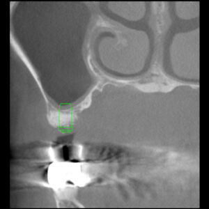 2009年3月にサイナスリフトを行なった症例（40代女性　上あご奥歯欠損）