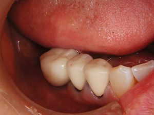 2009年3月に完治の症例（40代女性　下あご奥歯欠損）