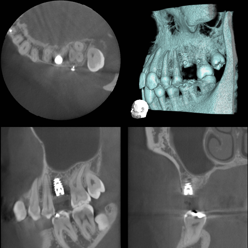 2017年3月　上あご奥歯　サイナスリフト以外の骨造成はソーセージテクニック
