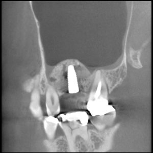 2016年6月にサイナスリフトをおこなった症例（30代女性　右あご奥歯欠損　サイナスリフト）