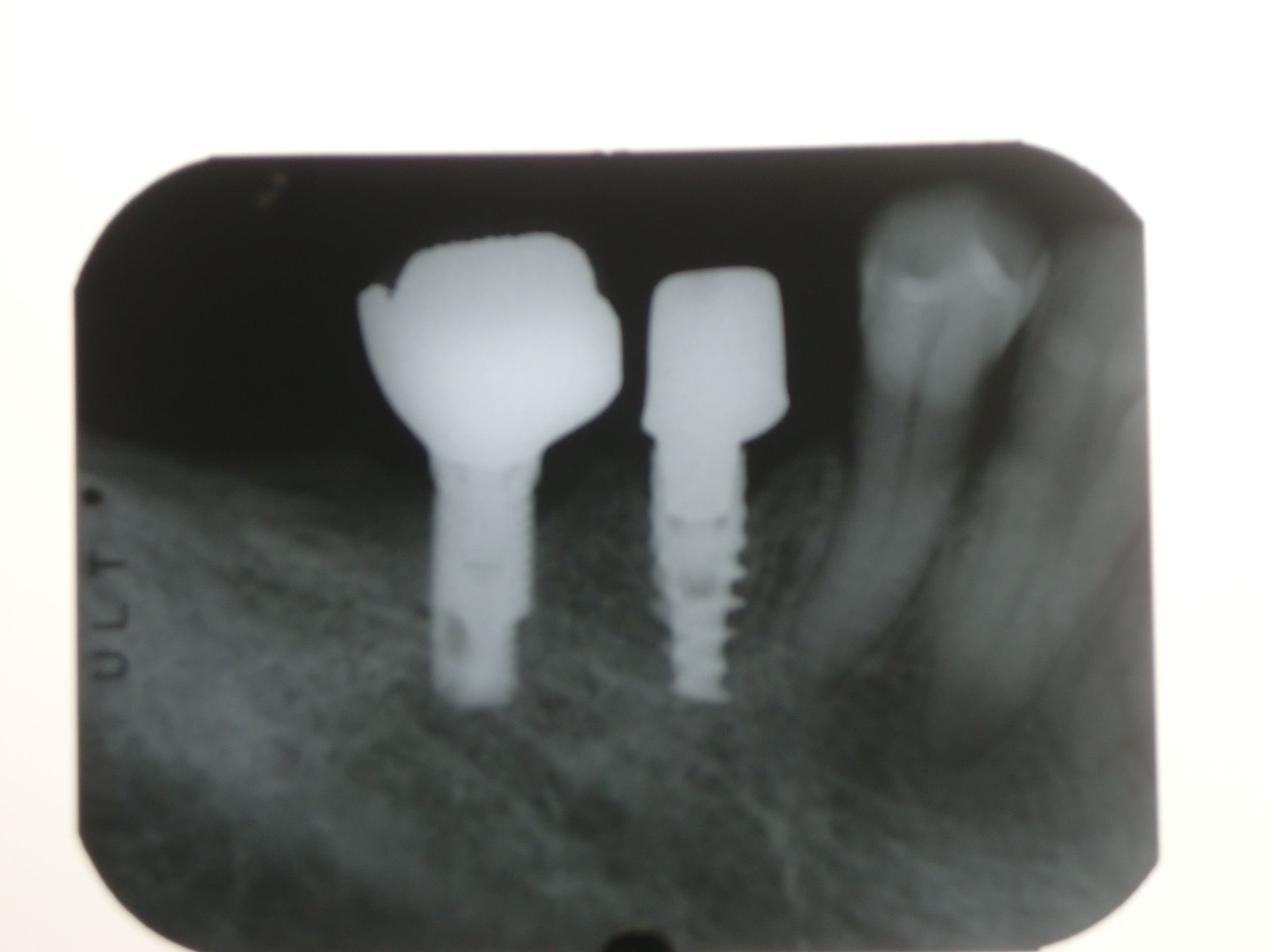 進化するインプラント審美材料