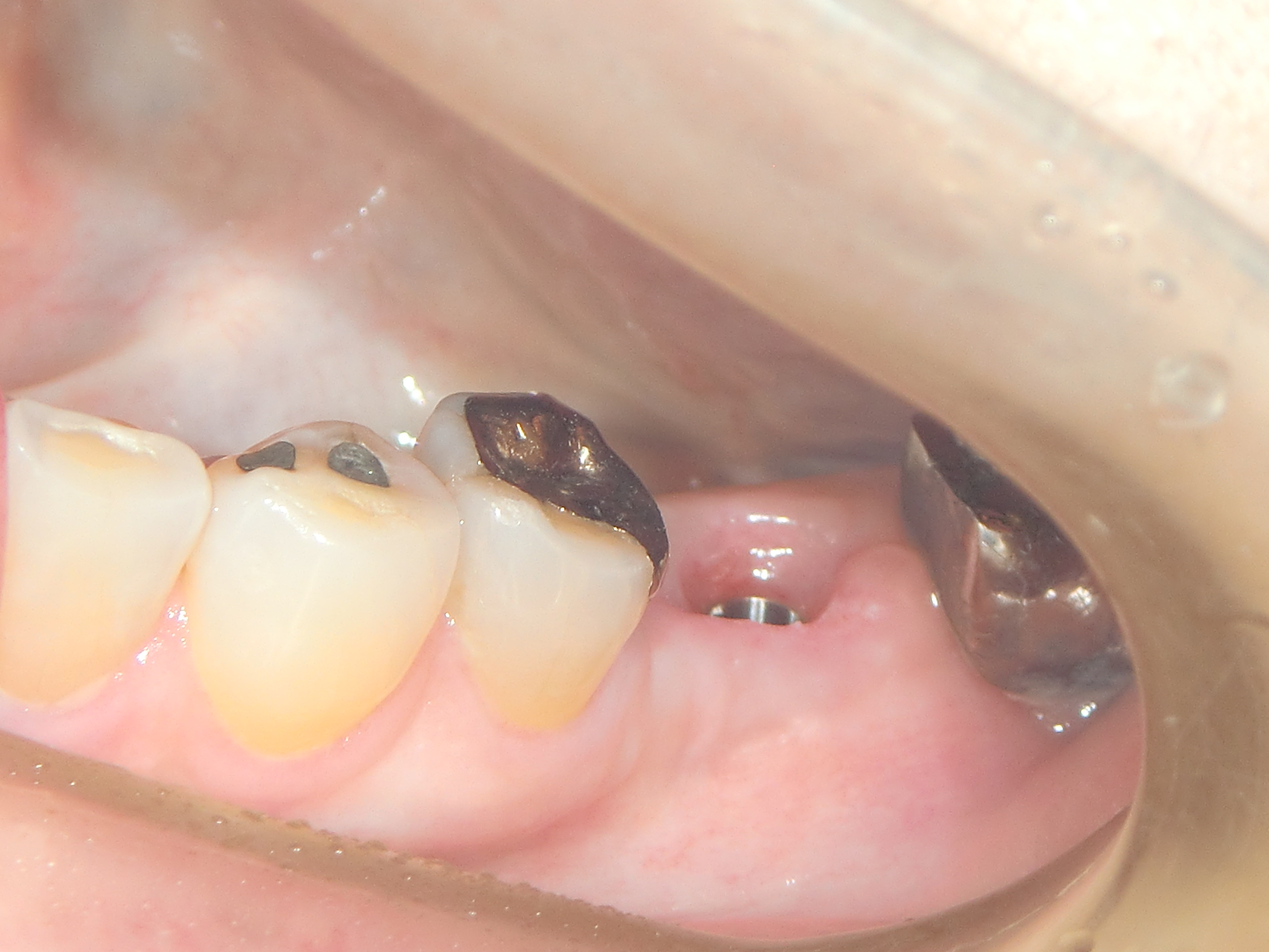 審美インプラントの極意