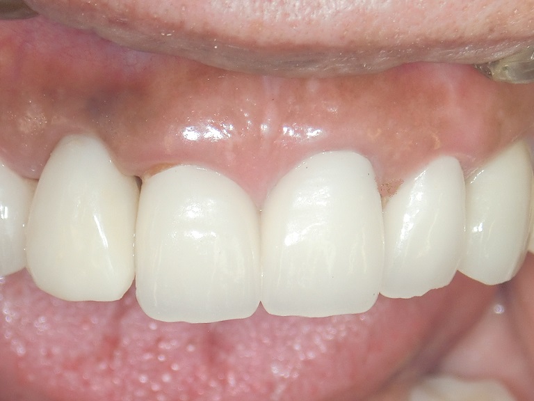 プラスチックサージェリー・歯肉整形