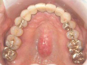 2018年1月に完治の症例（60代女性　前歯インプラント全体的治療）