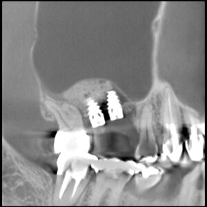 サイナスリフトとは　　（2018年3月の症例　50代男性）