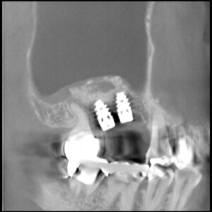 スリットリフト法　上あごに骨が少ない４０代男性のインプラント治療