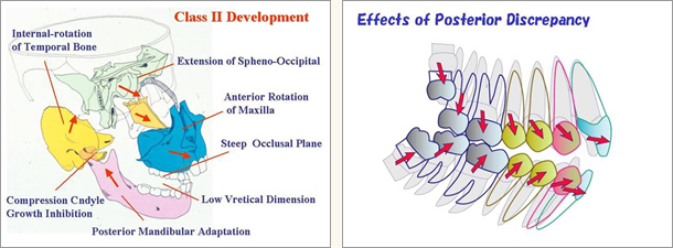 ラテラルスリット法について