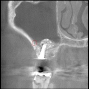 後上歯槽動脈を避けたラテラルスリット法　50代男性サイナスリフト