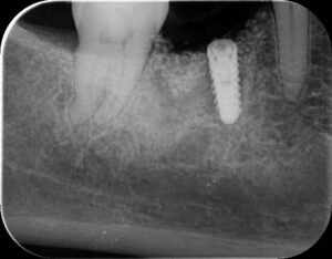 50代　女性　下あご奥歯　インプラント治療