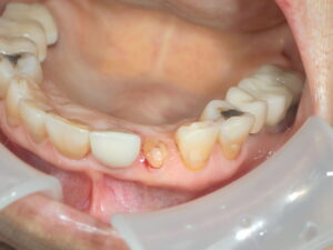 症例200701　前歯抜歯即時インプラント治療　審美的治療　80代女性　